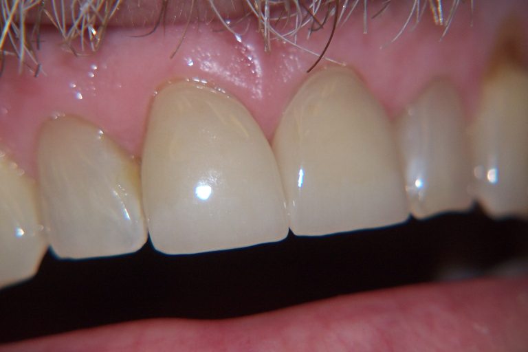 Before and After - Arcari Dental Laboratory – Full Service